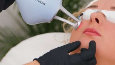 Laser tulowy - resurfacing twarzy
