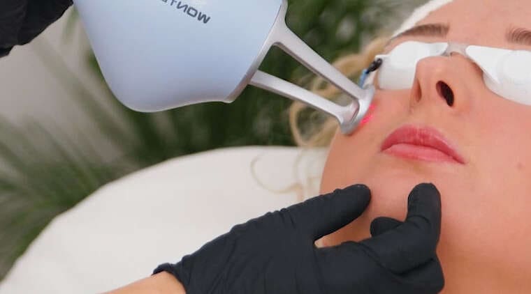 Laser tulowy - resurfacing twarzy