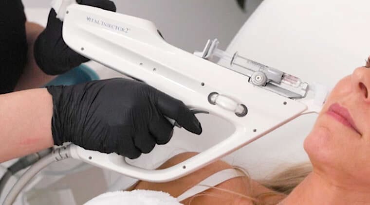 Mezoterapia mikroigłowa próżniowa - Vital Injector